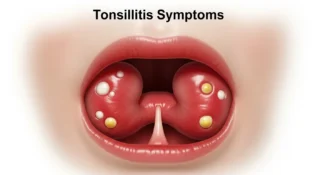 What Does Tonsillitis Look Like: Symptoms, Visual Signs, and Online Use